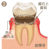歯周病進行イメージ2